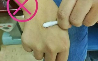 针孔笔戳到手怎么去除（针孔笔戳到手怎么去除伤口）