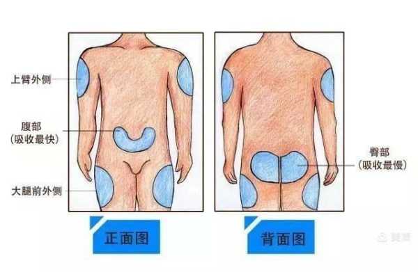 怎么伪造出吊液针孔（糖尿病人输糖怎么加胰岛素）-第1张图片-安保之家